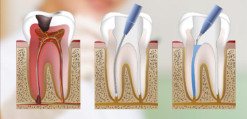 Endodoncia