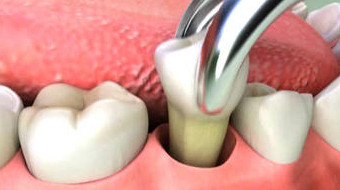 extraccion dental