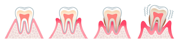 Periodoncia